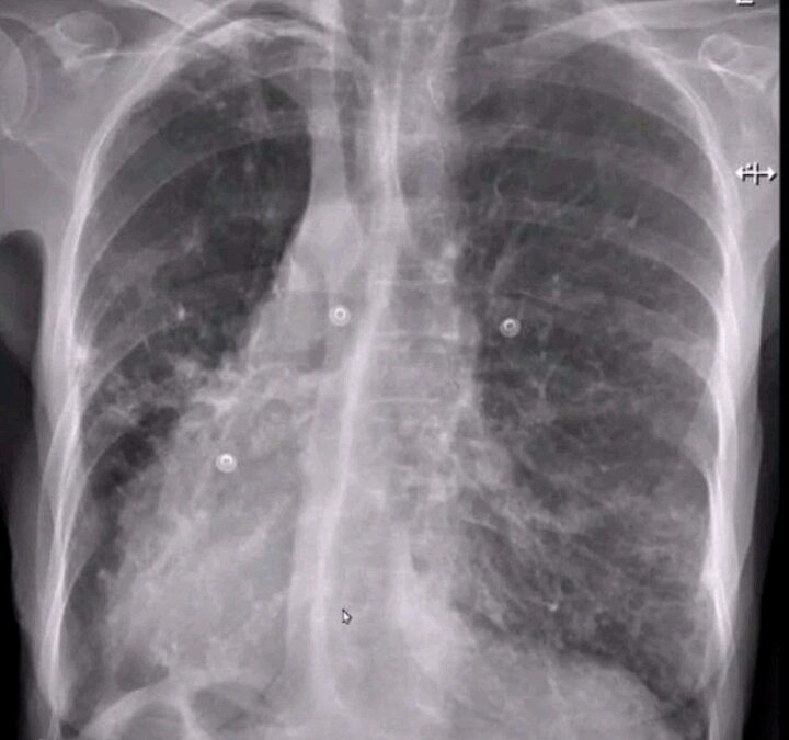 Kartangener's syndrome