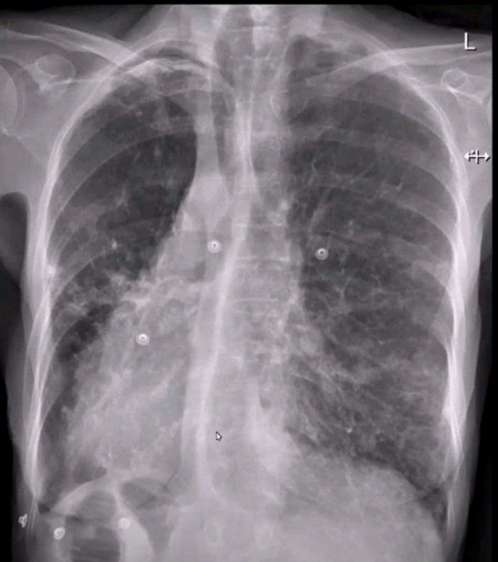 Kartangener's syndrome