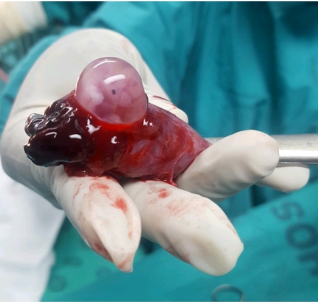 salpingostomy the ectopic pregnancy 
