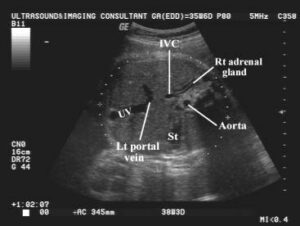 Fetal Pole