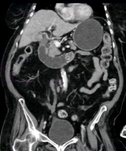  Bouveret Syndrome