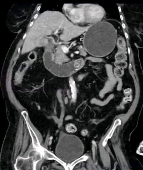 Bouveret Syndrome