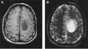 Oligodendroglioma