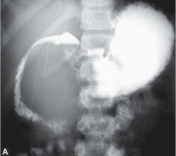 Barium Meal