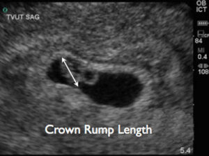 Crown-rump length (CRL) of 7 weeks ultrasound.