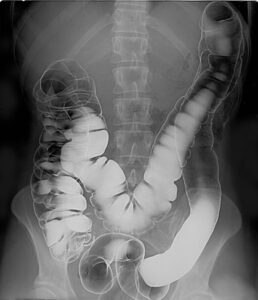 barium enema