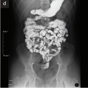 Barium Meal Follow Through (BMFT)
