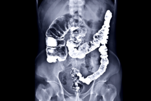 Barium Enema.