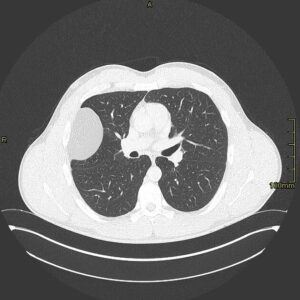 Pleural lipoma