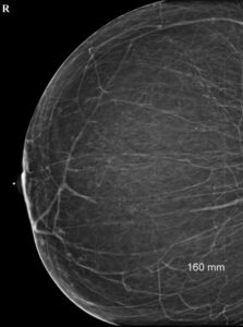 gigantomastia of mamography