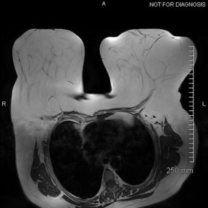 gigantomastia of mri