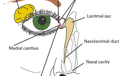 Dacrocystography (DCG).