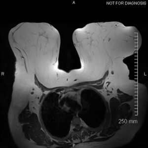 gigantomastia of mri