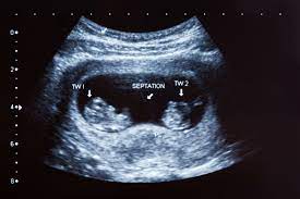 8 week ultrasound with Multiple pregnancy