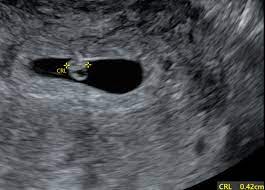 8 week ultrasound with Small crown-rump length