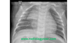thymic hyperplasia