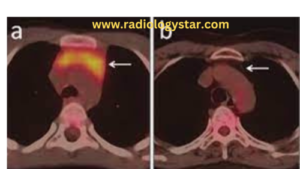thymic hyperplasia