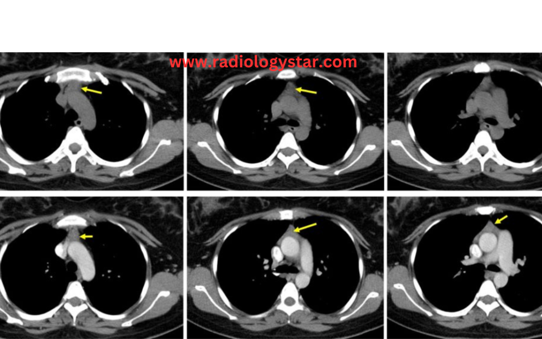 thymic hyperplasia