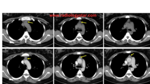 thymic hyperplasia