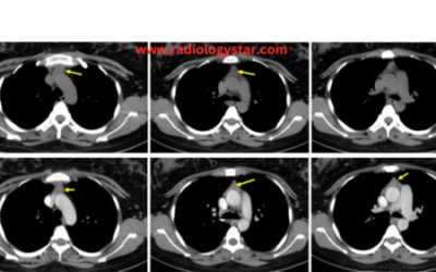 Thymic Hyperplasia