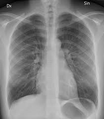 Plain X-ray