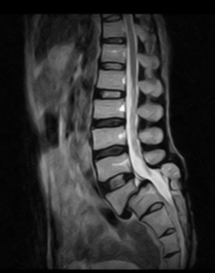 Anterolisthesis